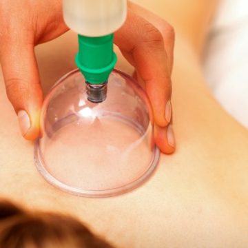 Cupping